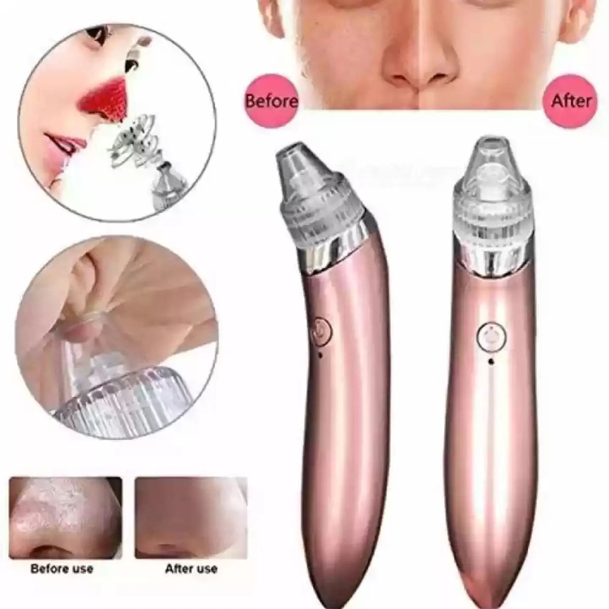 Electric Blackhead Remover Vacuum – Acne & Black Spot Cleaner
